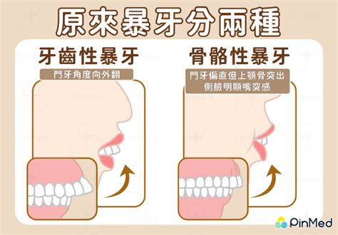 門牙暴牙面相|【門牙暴牙面相】如何從門牙暴牙面相洞悉你一生的富貴運勢